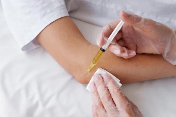 PRP treatment photo
